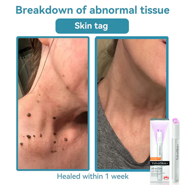 All-in-One CO₂ Laser Eraser Pen | Removes Moles, Warts, Skin Flaws & Pigmentation