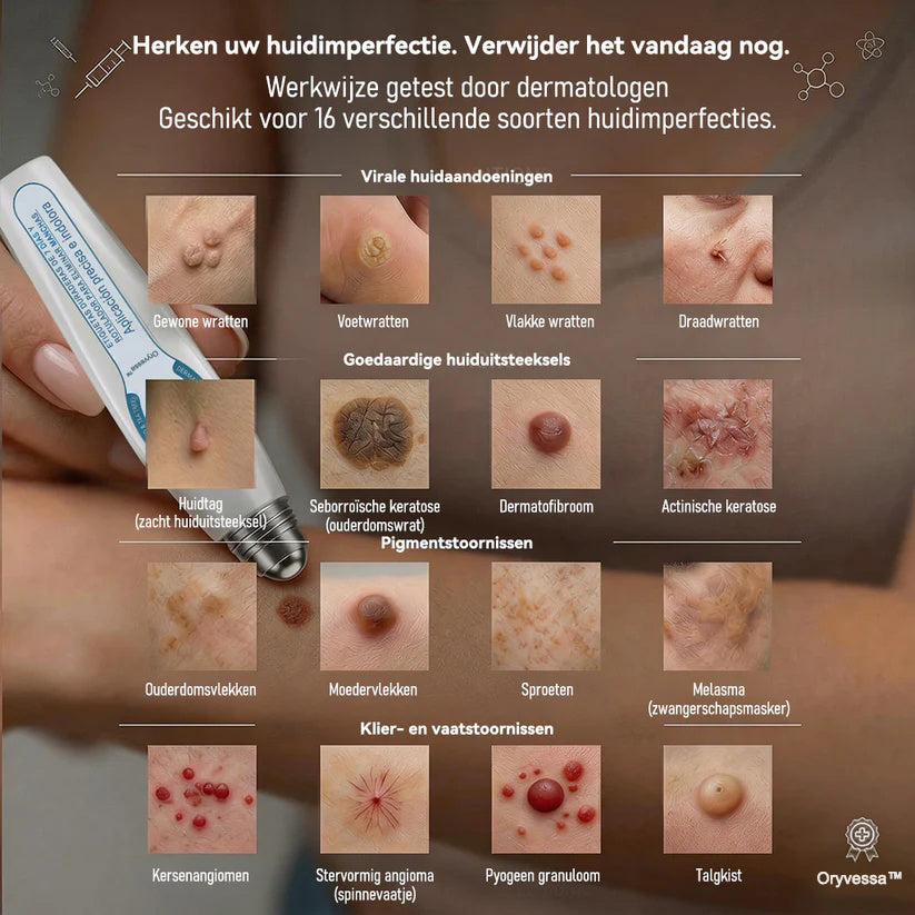 🔥Officiële merkshop | 🖊️Oryvessa™ 7-daagse wratten- en vlekkenverwijderaar (pijnstillende applicator voor nauwkeurig aanbrengen, laat geen littekens achter)